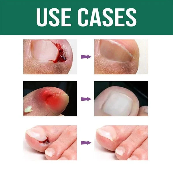 Anti Paronychia Relief Oil - Nail Fungus Oil
